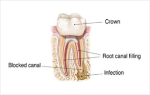 Re-Treatment Endodontics Dubai