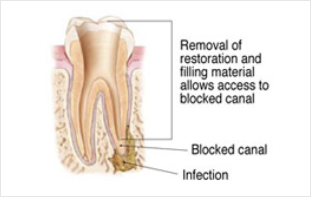 Re-Treatment Endodontics Dubai