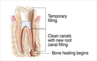 Root Canal Dubai