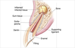 Surgical Endodontics Dubai