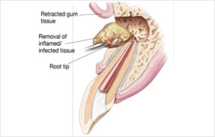 Surgical Endodontics Dubai