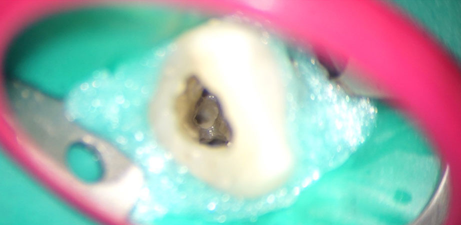 Root Canal specialist Dubai