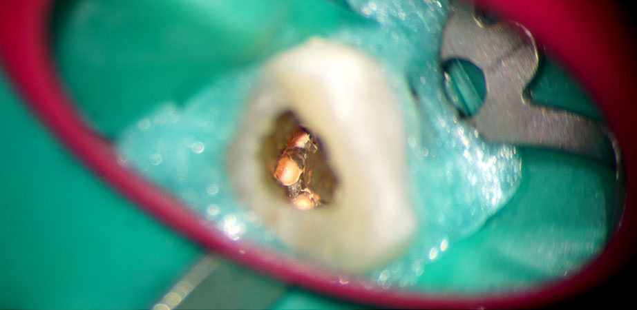 Endodontist in Dubai