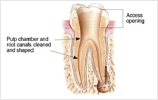 Root Canal Treatment Dubai